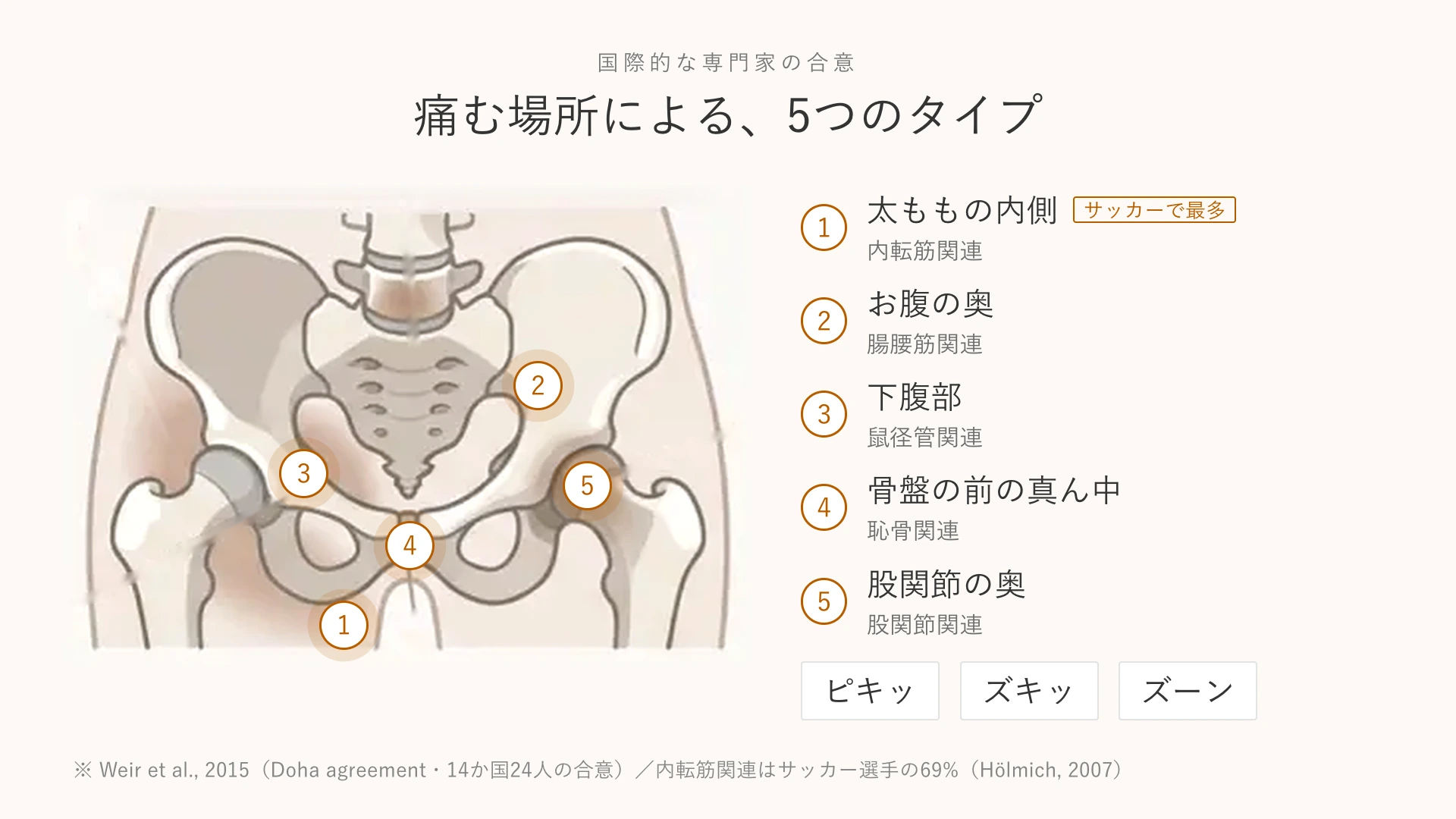 グロインペイン症候群の5つのタイプを骨盤の図で示した一覧。太ももの内側（内転筋関連）はサッカー選手で最多、ほかにお腹の奥、下腹部、恥骨、股関節の奥