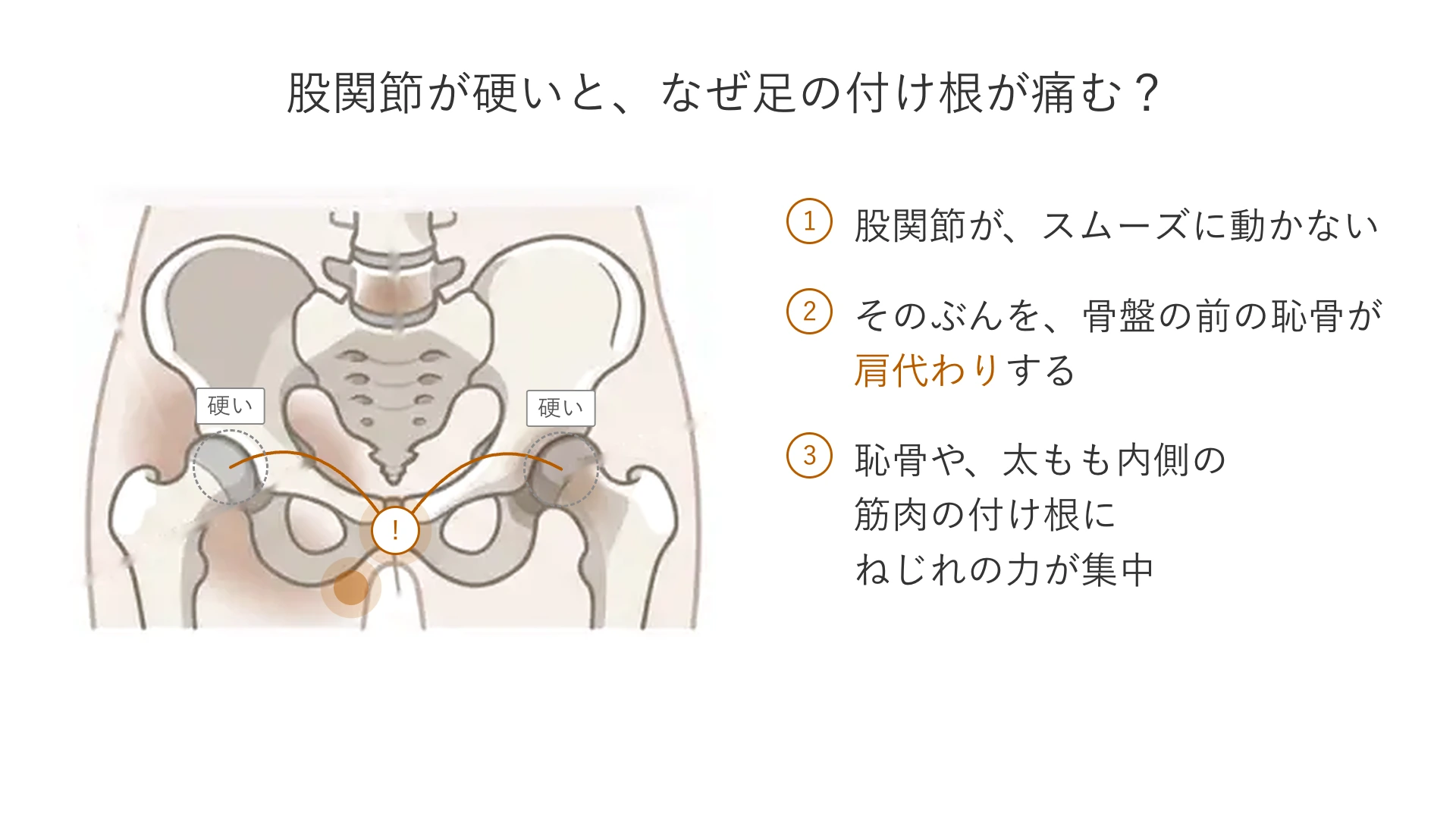 股関節がスムーズに動かないぶんを骨盤の前の恥骨が肩代わりし、恥骨や太もも内側の筋肉の付け根にねじれの力が集中する流れを示した図