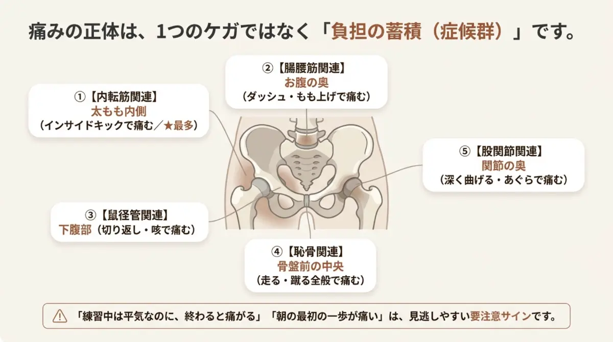 グロインペイン症候群で痛む場所の5タイプ。内転筋関連・腸腰筋関連・鼠径管関連・恥骨関連・股関節関連を骨盤の図で示した解説
