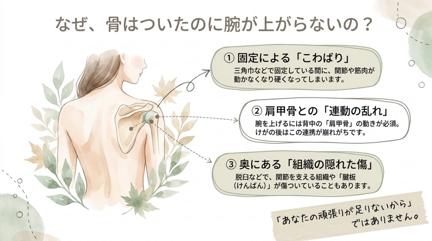 骨がついたのに腕が上がらない3つの理由の図。固定によるこわばり、肩甲骨との連動の乱れ、関節を支える組織の傷
